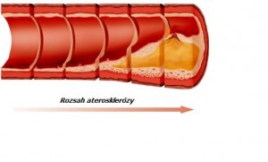 ateroskleroza